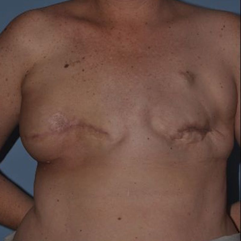 Breast Reconstruction Before & After Gallery - Patient 873748 - Image 1
