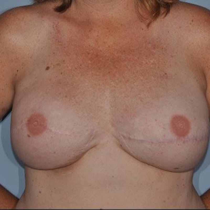 Breast Reconstruction Before & After Gallery - Patient 873748 - Image 2