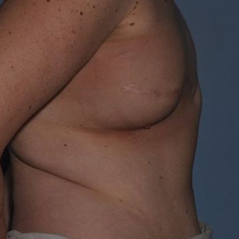 Breast Reconstruction Before & After Gallery - Patient 873748 - Image 3