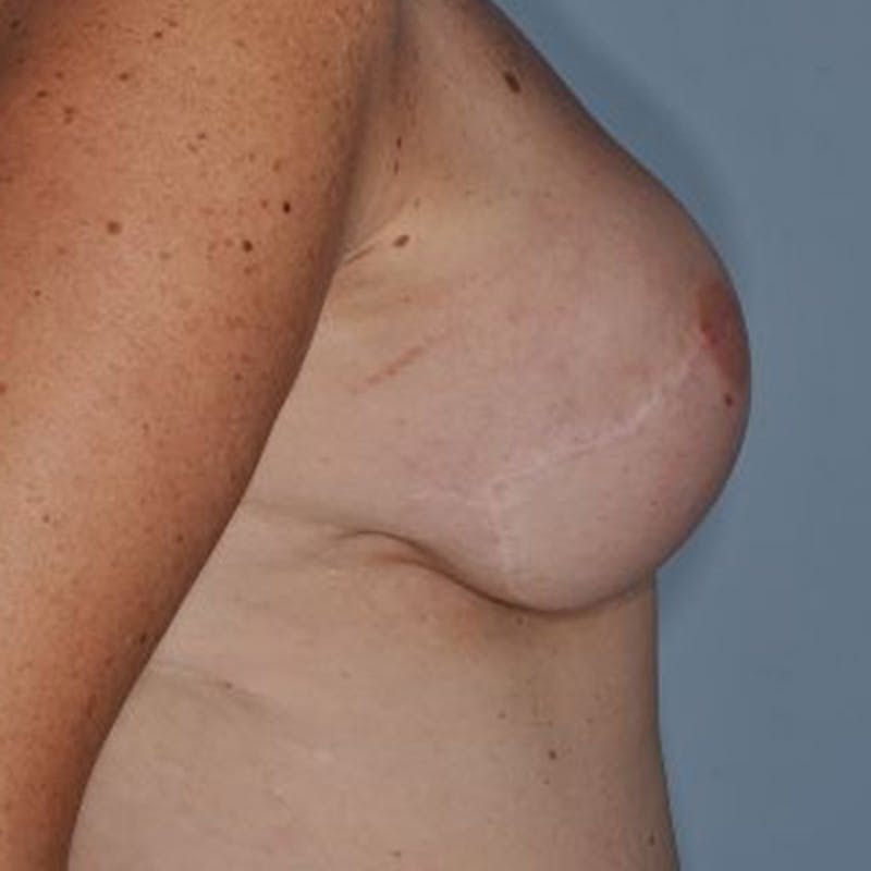 Breast Reconstruction Before & After Gallery - Patient 873748 - Image 4