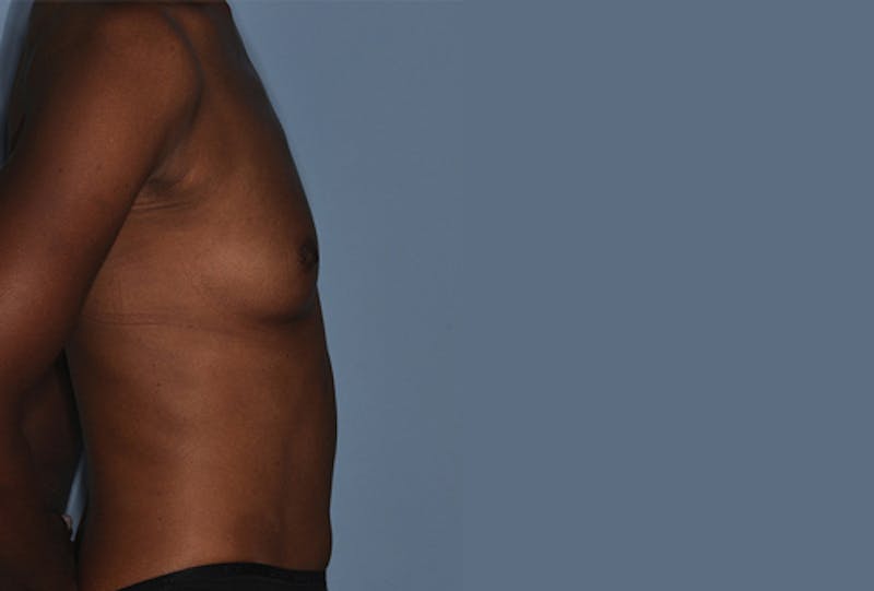 Breast Fat Transfer Before & After Gallery - Patient 268901 - Image 5