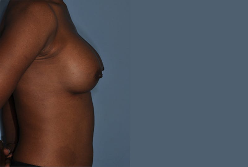 Breast Fat Transfer Before & After Gallery - Patient 268901 - Image 6
