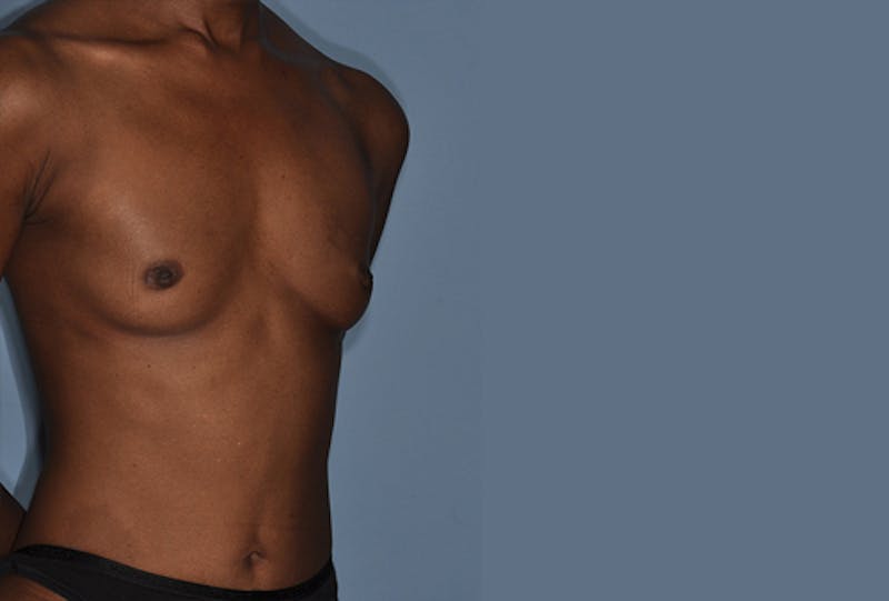 Breast Fat Transfer Before & After Gallery - Patient 268901 - Image 3