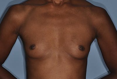 Breast Fat Transfer Before & After Gallery - Patient 268901 - Image 1