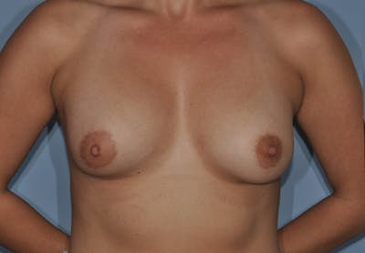 Breast Fat Transfer Before & After Gallery - Patient 292717 - Image 2