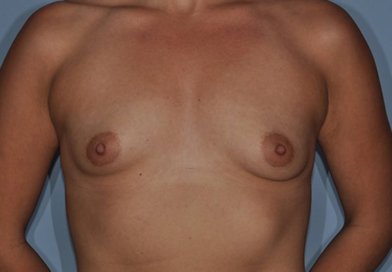 Breast Fat Transfer Before & After Gallery - Patient 292717 - Image 1