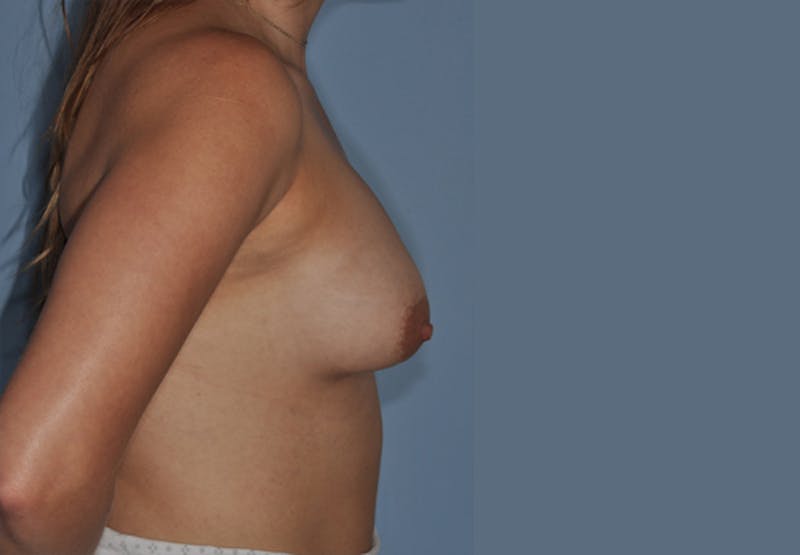 Breast Fat Transfer Before & After Gallery - Patient 292717 - Image 4