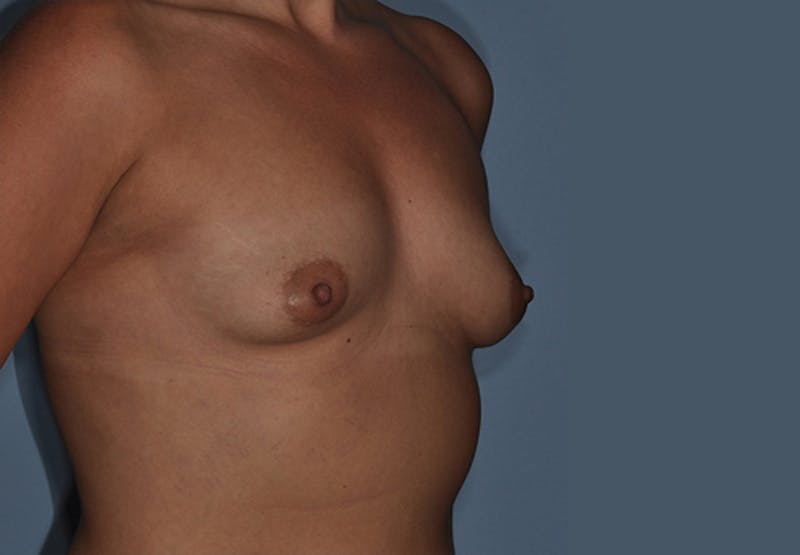 Breast Fat Transfer Before & After Gallery - Patient 292717 - Image 5