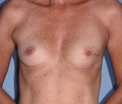 Breast Fat Transfer Before & After Gallery - Patient 248792 - Image 1