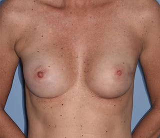 Breast Fat Transfer Before & After Gallery - Patient 248792 - Image 2