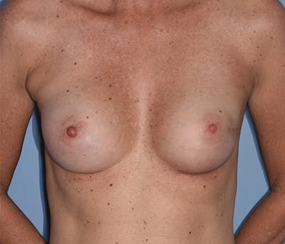 Breast Fat Transfer Before & After Gallery - Patient 248792 - Image 2