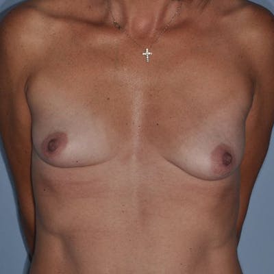 Breast Fat Transfer Before & After Gallery - Patient 445853 - Image 1