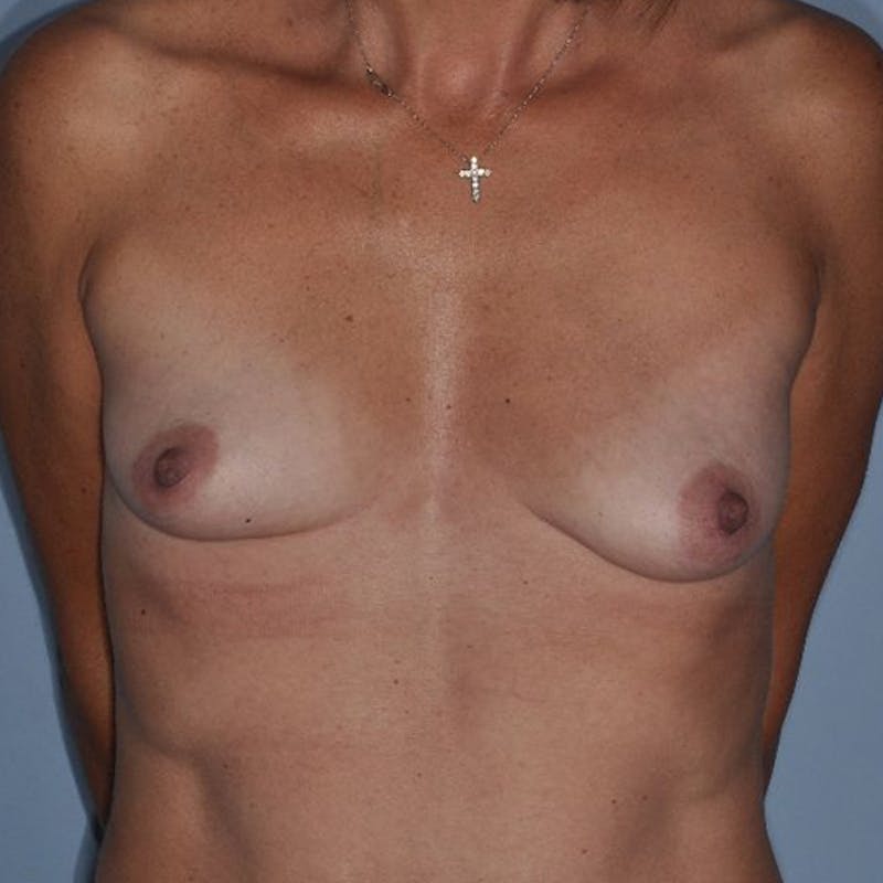 Breast Fat Transfer Before & After Gallery - Patient 445853 - Image 1