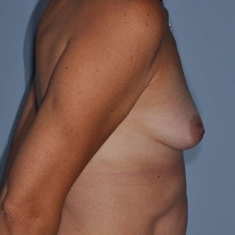Breast Fat Transfer Before & After Gallery - Patient 445853 - Image 5