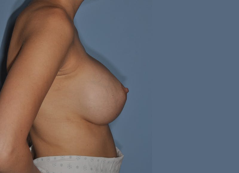 Breast Revision Before & After Gallery - Patient 127928 - Image 6