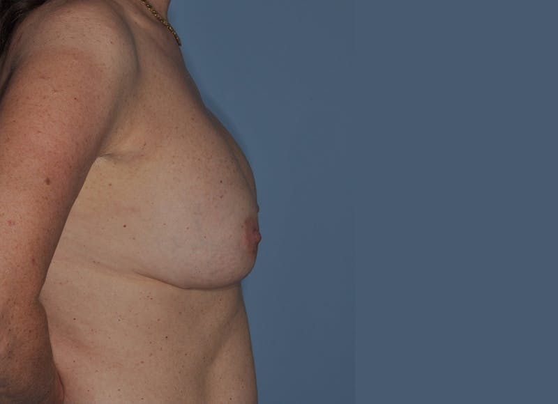 Breast Revision Before & After Gallery - Patient 216358 - Image 5