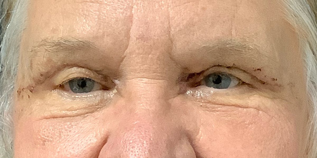 Eyelid Surgery (Blepharoplasty) Before & After Gallery - Patient 338492 - Image 2