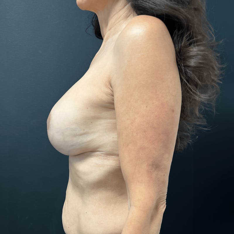 Breast Lift Before & After Gallery - Patient 381600 - Image 6