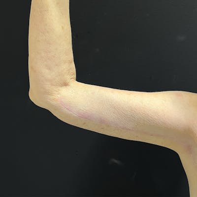 Brachioplasty Before & After Gallery - Patient 732105 - Image 2