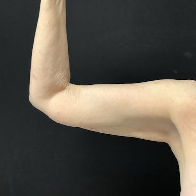 Brachioplasty Before & After Gallery - Patient 732105 - Image 1