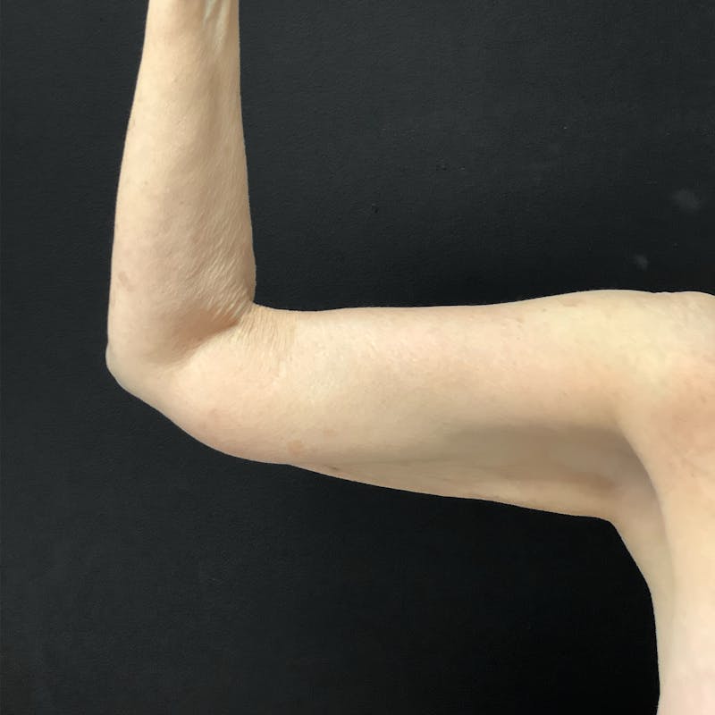 Brachioplasty Before & After Gallery - Patient 732105 - Image 1
