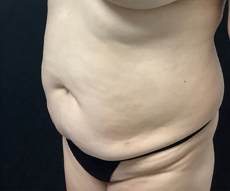 Tummy Tuck (Abdominoplasty) Before & After Gallery - Patient 321974 - Image 3
