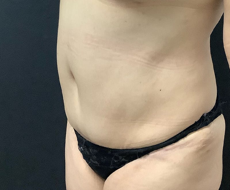 Tummy Tuck (Abdominoplasty) Before & After Gallery - Patient 321974 - Image 4