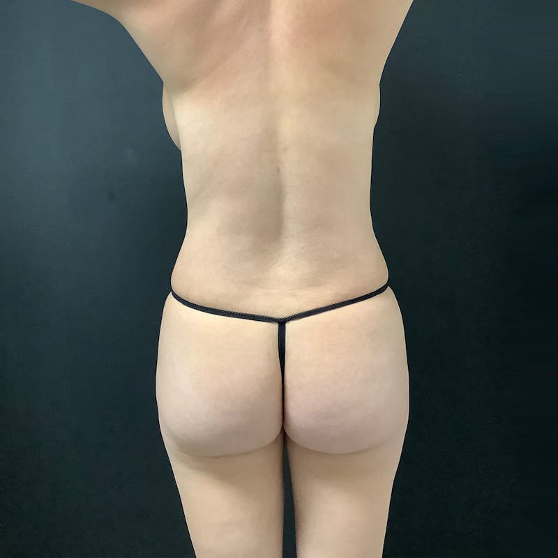 Mommy Makeover Before & After Gallery - Patient 253593 - Image 8
