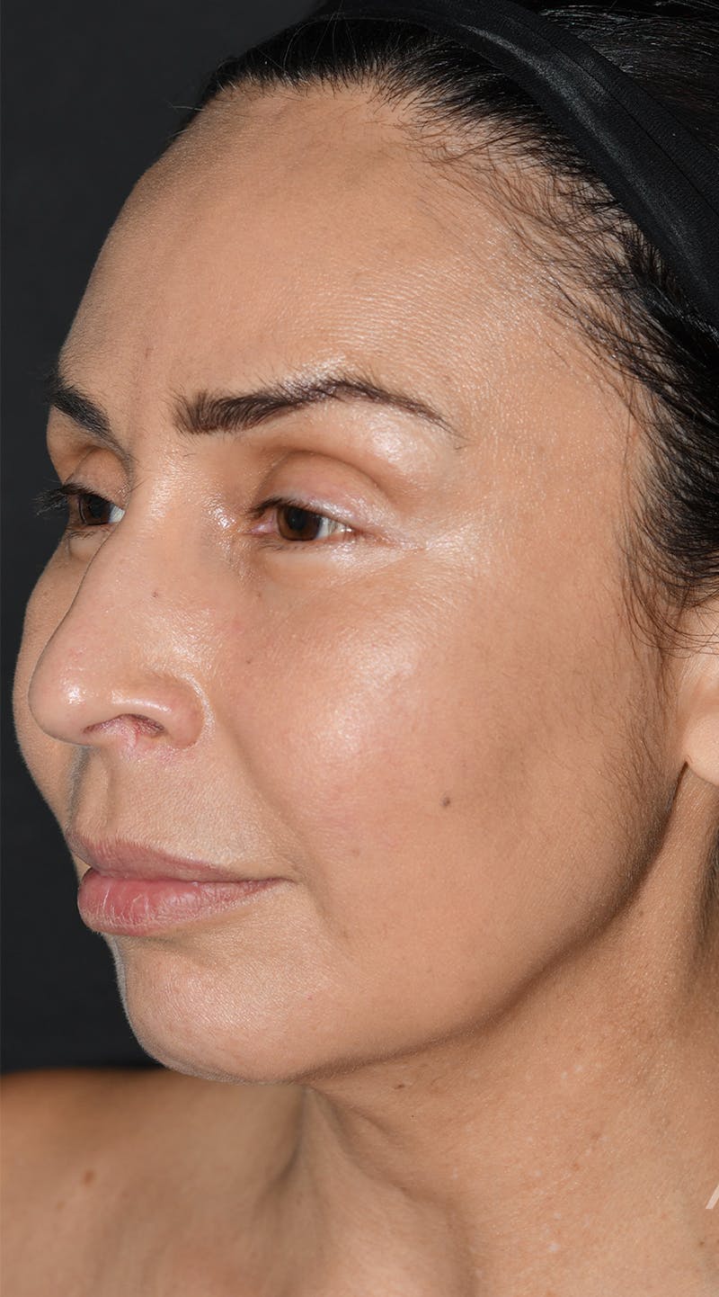 Facelift Before & After Gallery - Patient 326950 - Image 3