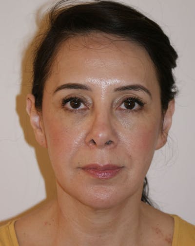 Facelift/Necklift Before & After Gallery - Patient 357852 - Image 1