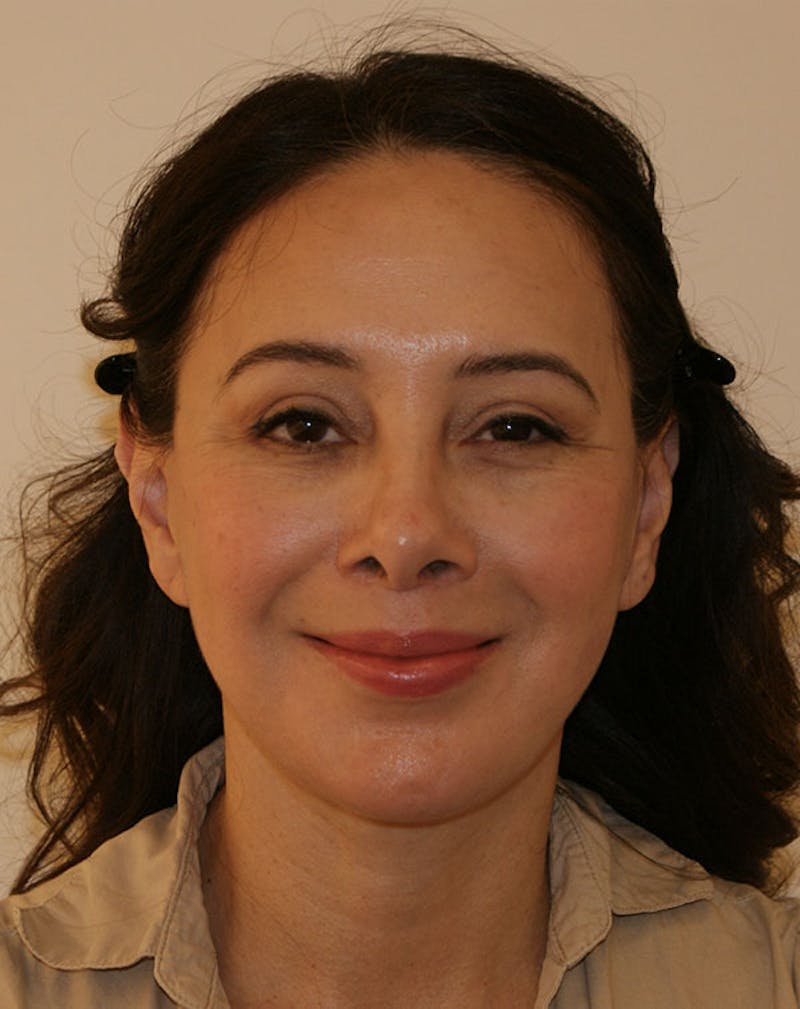 Facelift/Necklift Before & After Gallery - Patient 357852 - Image 4