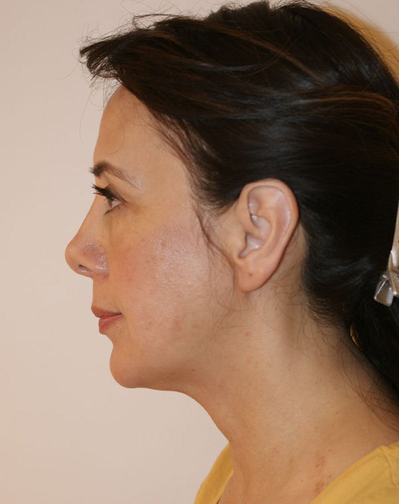 Facelift/Necklift Before & After Gallery - Patient 357852 - Image 7