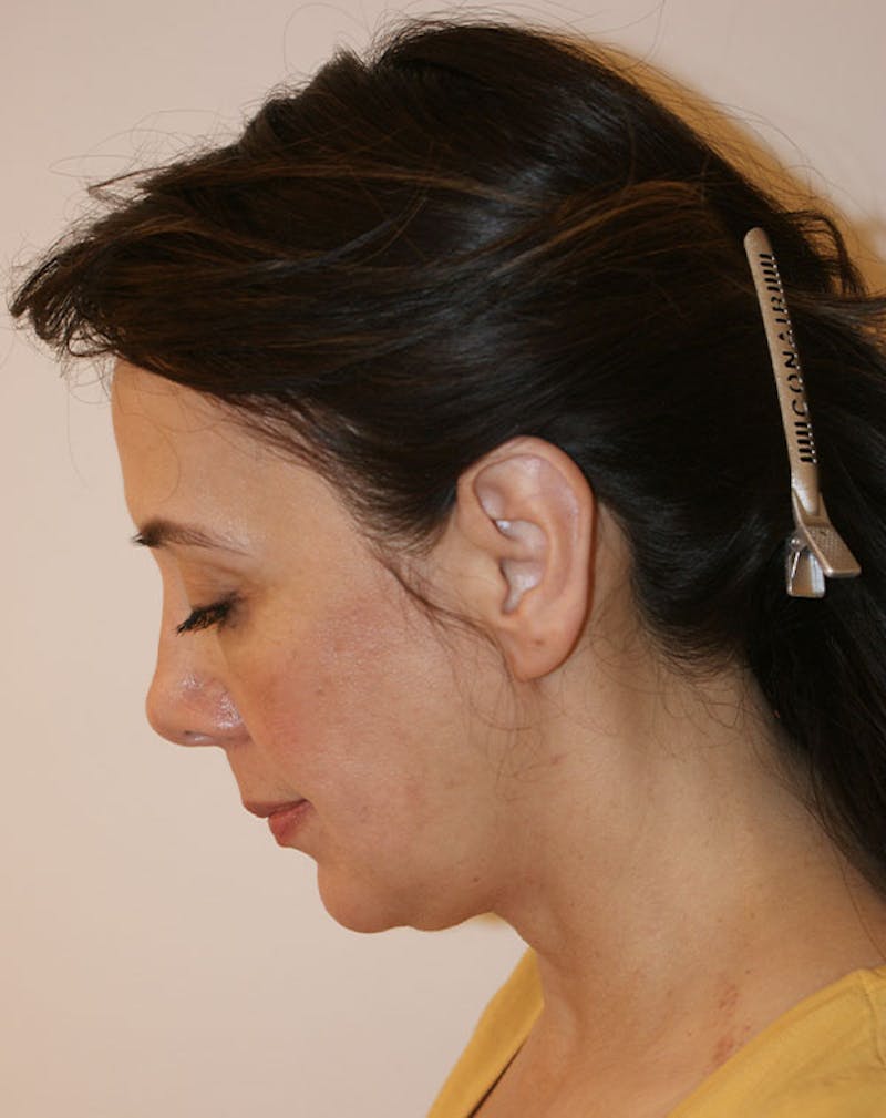 Facelift/Necklift Before & After Gallery - Patient 357852 - Image 9