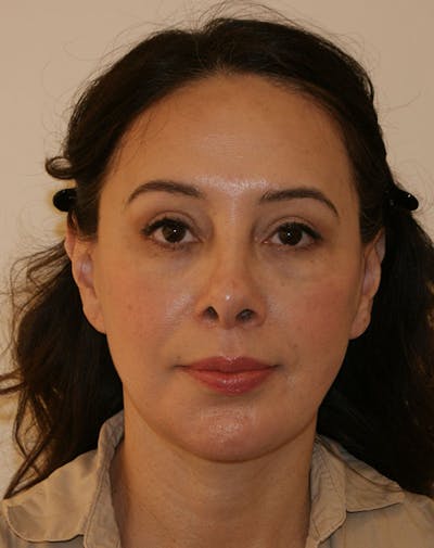 Facelift/Necklift Before & After Gallery - Patient 357852 - Image 2