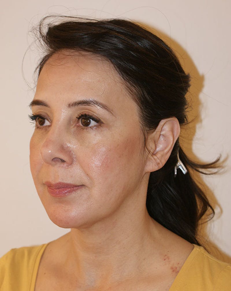 Facelift/Necklift Before & After Gallery - Patient 357852 - Image 5