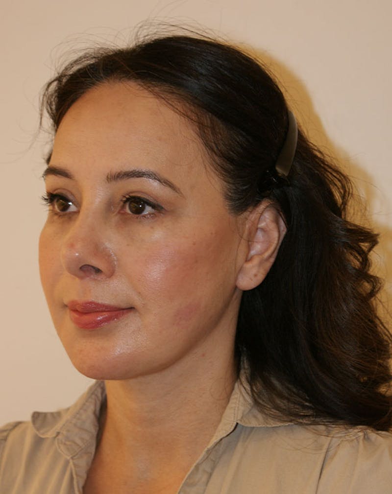 Facelift/Necklift Before & After Gallery - Patient 357852 - Image 6