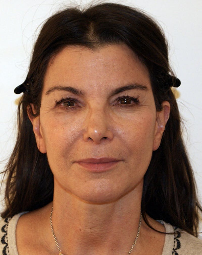Facelift/Necklift Before & After Gallery - Patient 196645 - Image 2