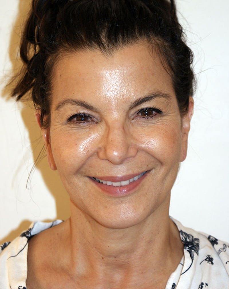Facelift/Necklift Before & After Gallery - Patient 196645 - Image 3