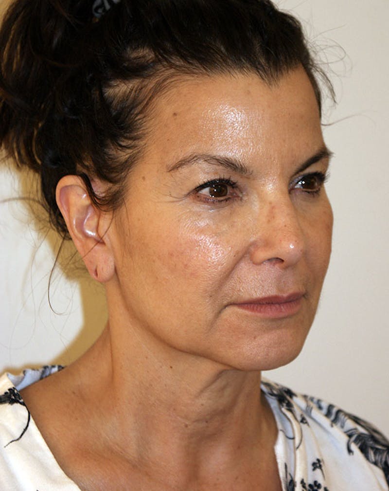Facelift/Necklift Before & After Gallery - Patient 196645 - Image 5