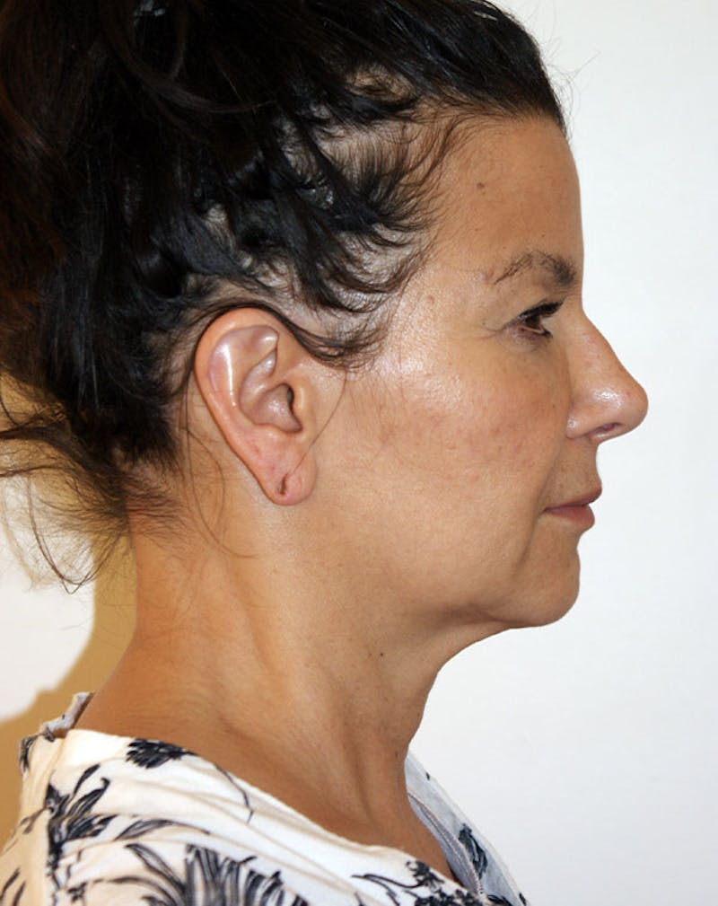 Facelift/Necklift Before & After Gallery - Patient 196645 - Image 7