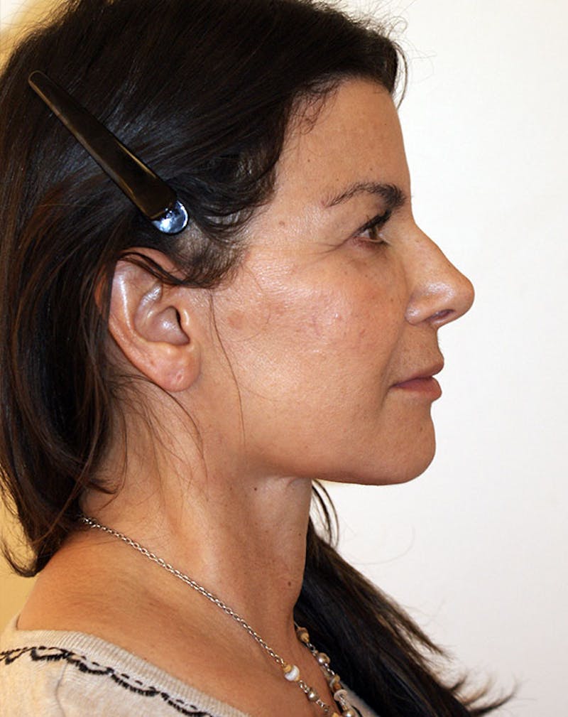 Facelift/Necklift Before & After Gallery - Patient 196645 - Image 8