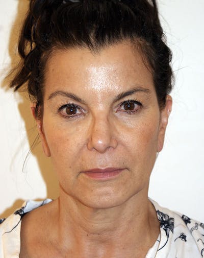 Facelift/Necklift Before & After Gallery - Patient 196645 - Image 1