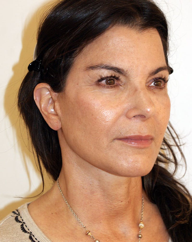 Facelift/Necklift Before & After Gallery - Patient 196645 - Image 6