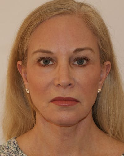 Facelift/Necklift Before & After Gallery - Patient 707826 - Image 2