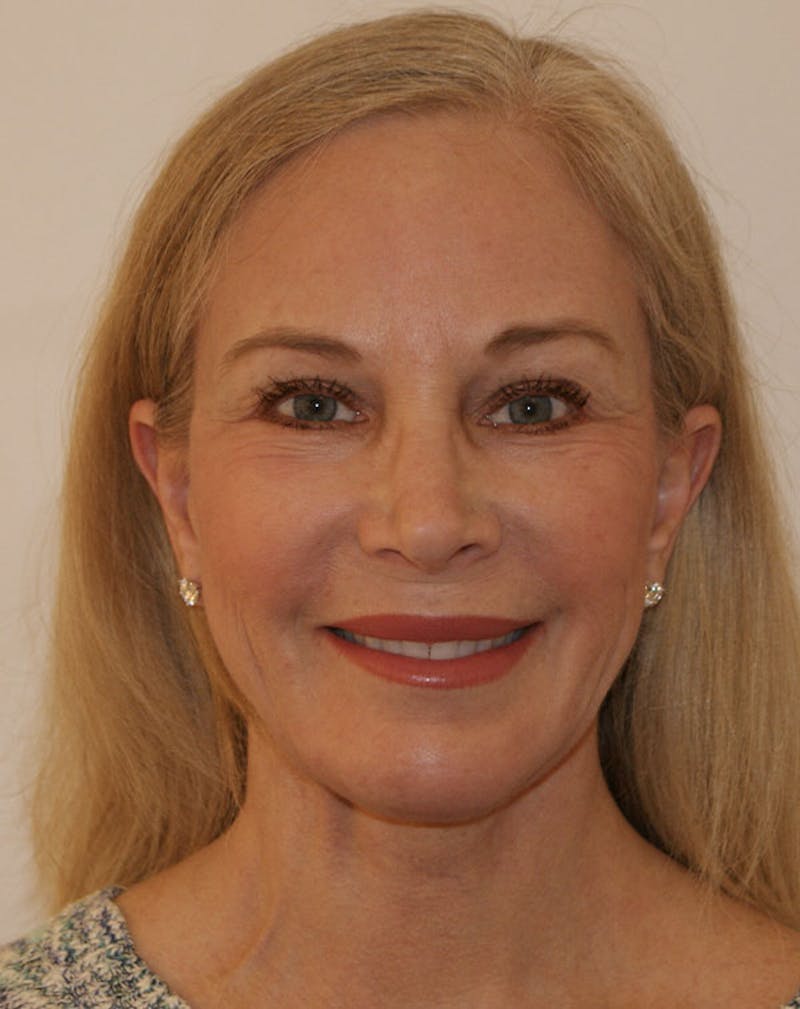 Facelift/Necklift Before & After Gallery - Patient 707826 - Image 4