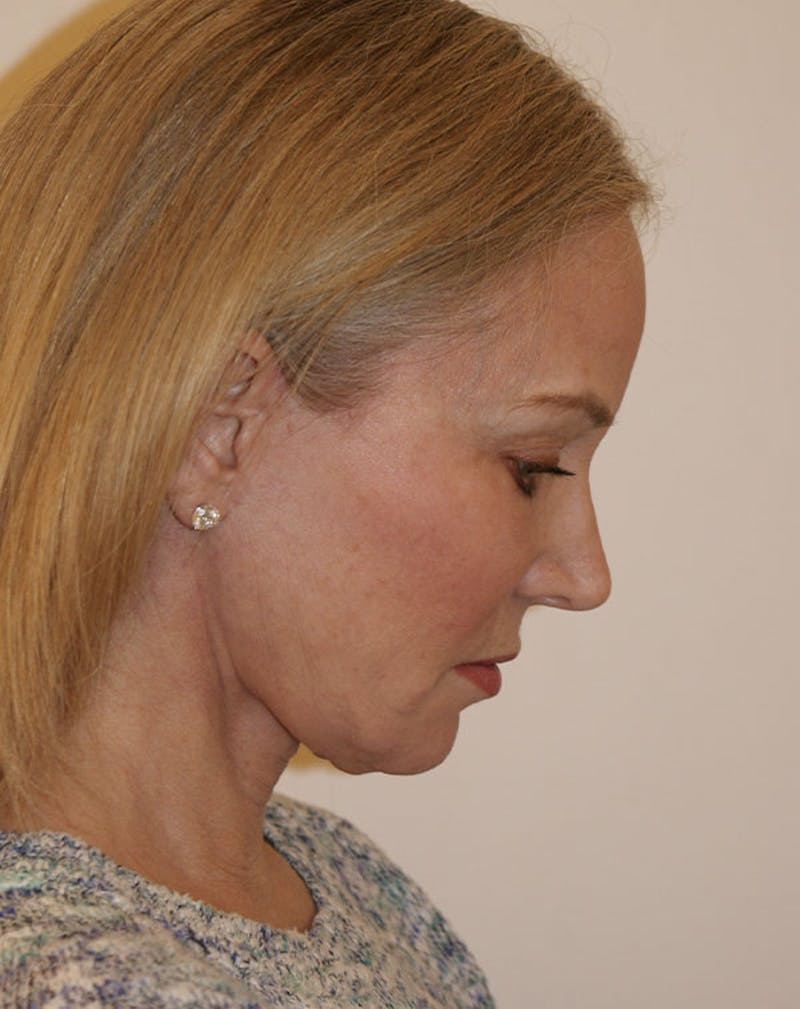 Facelift/Necklift Before & After Gallery - Patient 707826 - Image 10