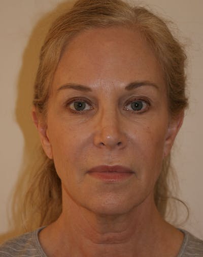 Facelift/Necklift Before & After Gallery - Patient 707826 - Image 1