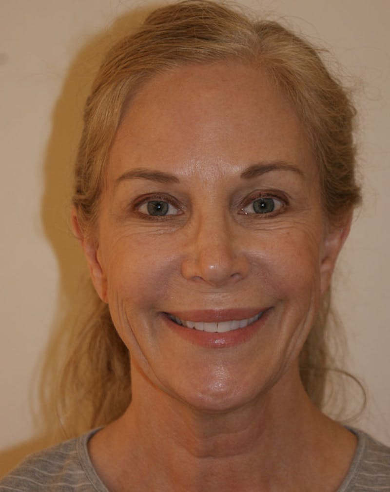 Facelift/Necklift Before & After Gallery - Patient 707826 - Image 3