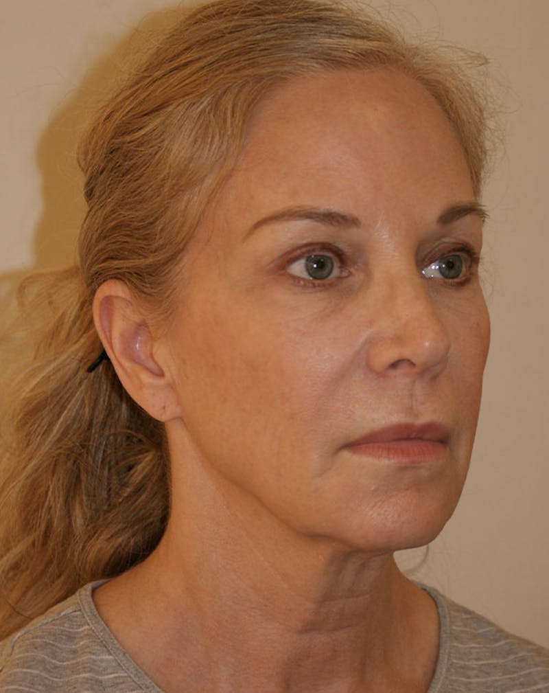 Facelift/Necklift Before & After Gallery - Patient 707826 - Image 5