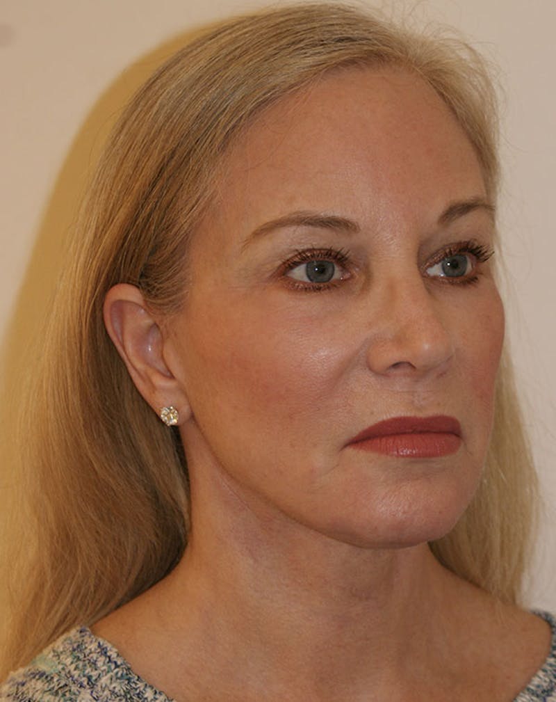 Facelift/Necklift Before & After Gallery - Patient 707826 - Image 6